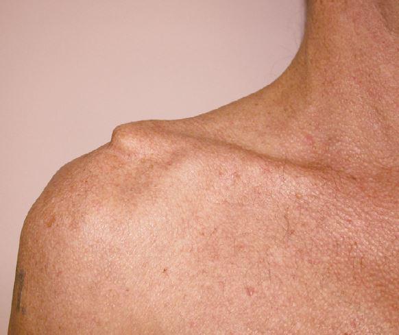 Lussazione acromio clavicolare1