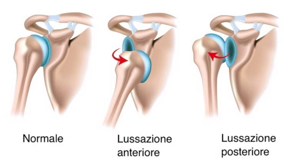 instabilità spalla