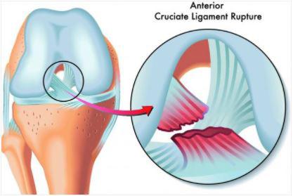 lesioni del legamento crociato2
