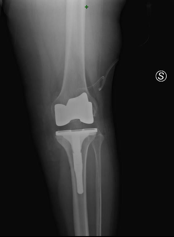 protesi ginocchio2