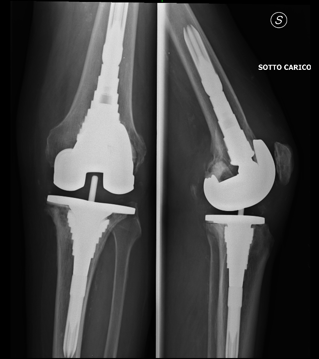protesi ginocchio4