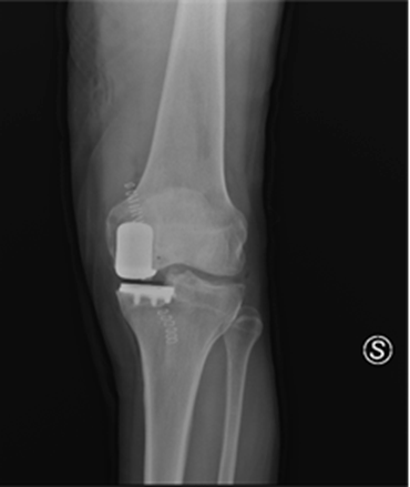 protesi monocompartimentale ginocchio2